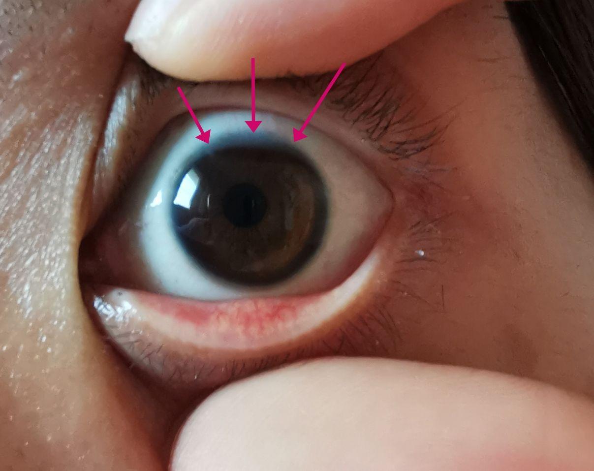 请问各位眼睛瞳孔上面有一层白色的膜,这是怎么回事? - 知乎