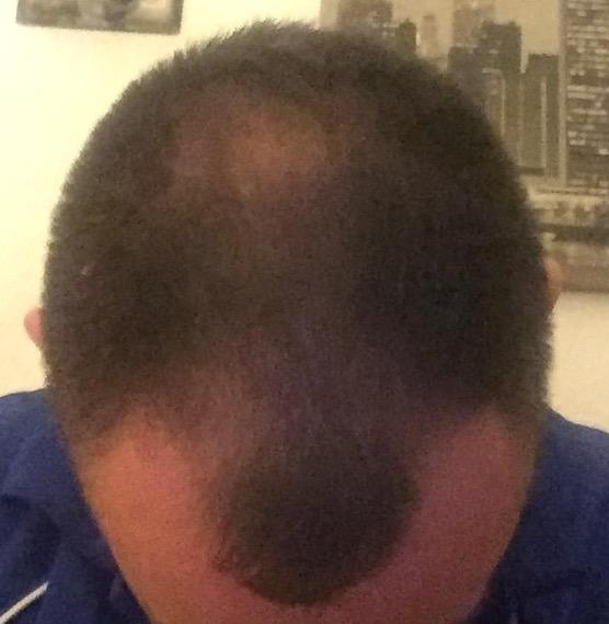 微针生发7:米诺地尔 滚针5周效果真好(图片)