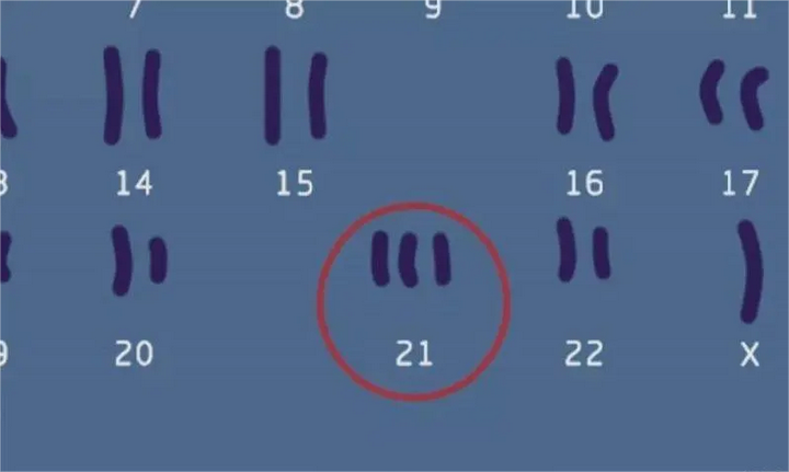 21三体综合征 染色体图片