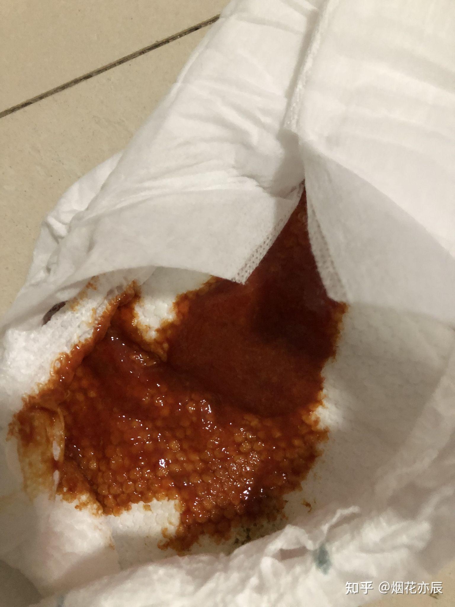 宝宝血便便怎么办血常规白细胞一个隐血阳性