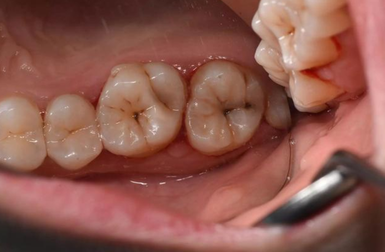 补牙洞会越补洞越大吗? - 知乎