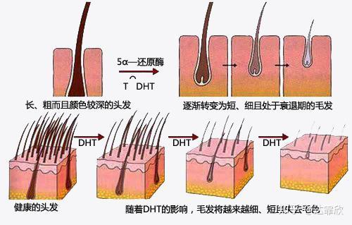 细软油秃发量危机别太担心,达霏欣教你如何科学使用米诺地尔生发 - 知乎