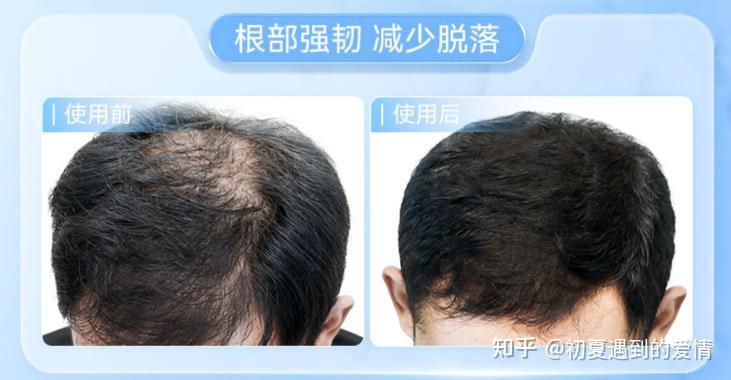 头旋的地方头发少怎么恢复?这洗发水不秃真别乱用! - 知乎