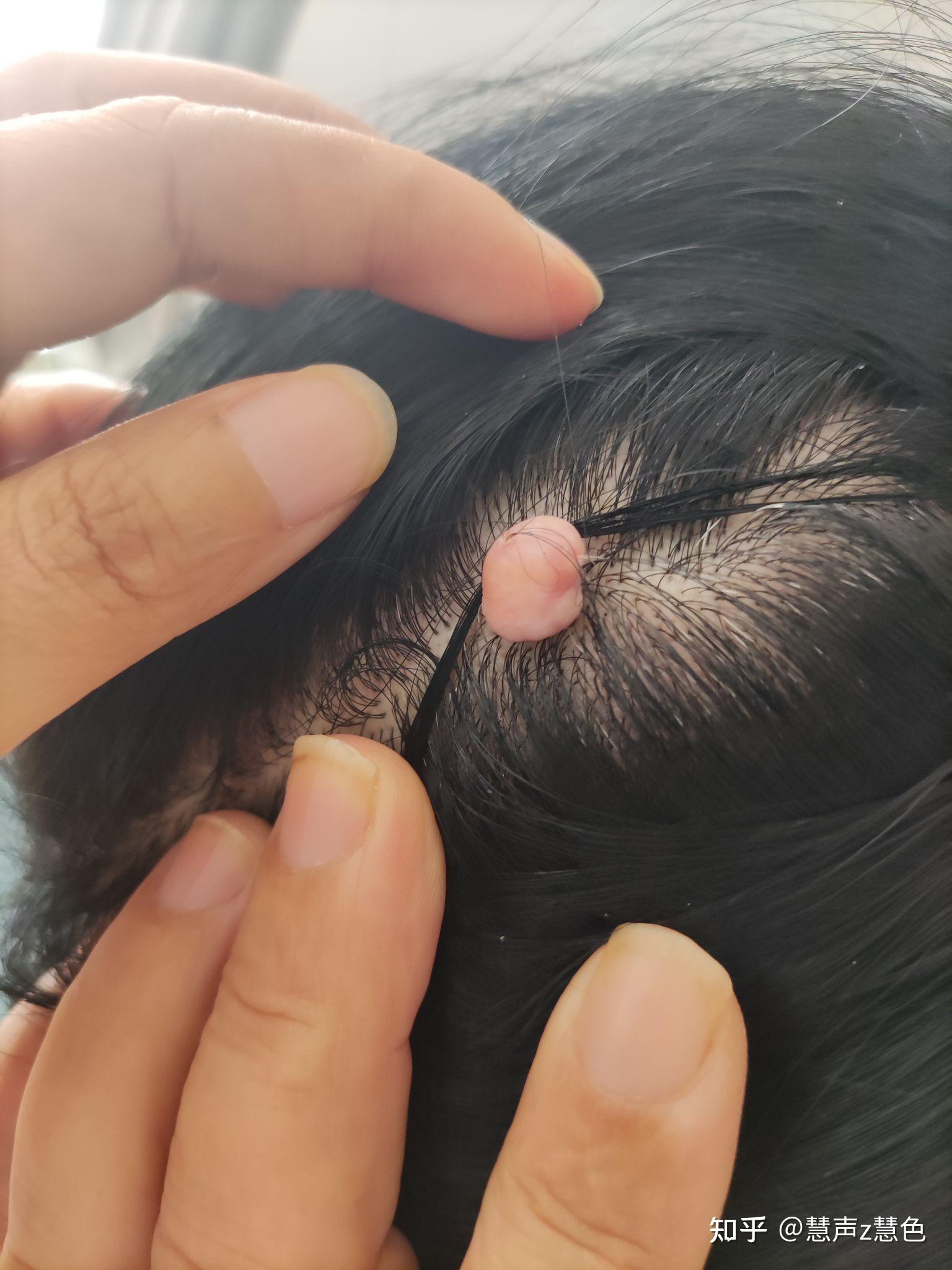 头上长了肉球有必要切掉么