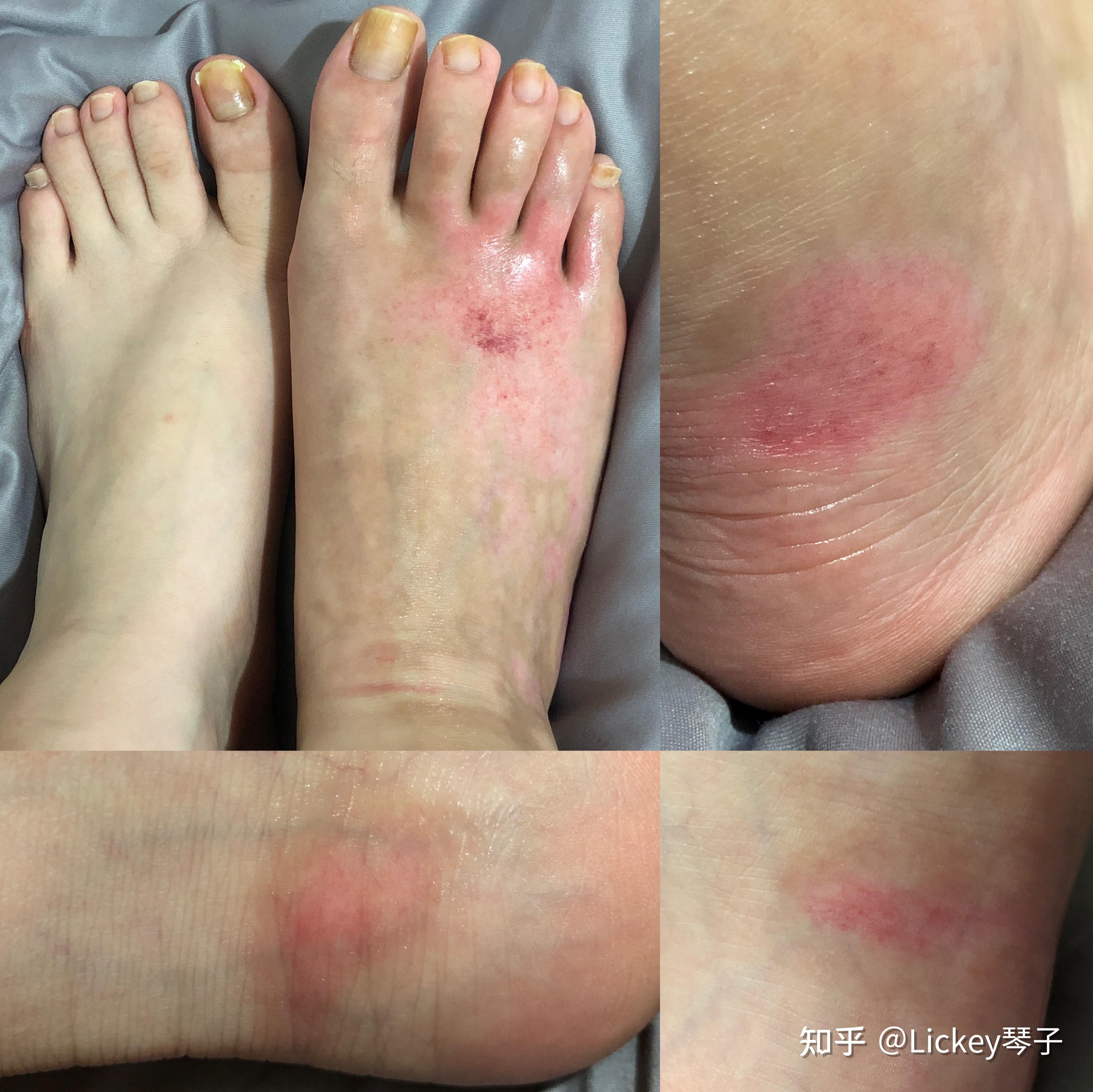 开水烫伤?怎么办?谢谢? - 知乎