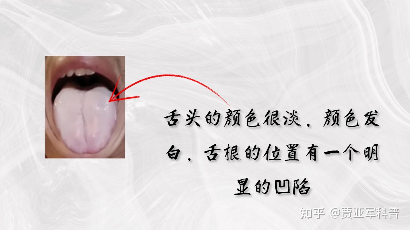 肾虚不虚,舌象告诉你!一分钟教会你分辨阴虚、阳虚、阴阳两虚 - 知乎