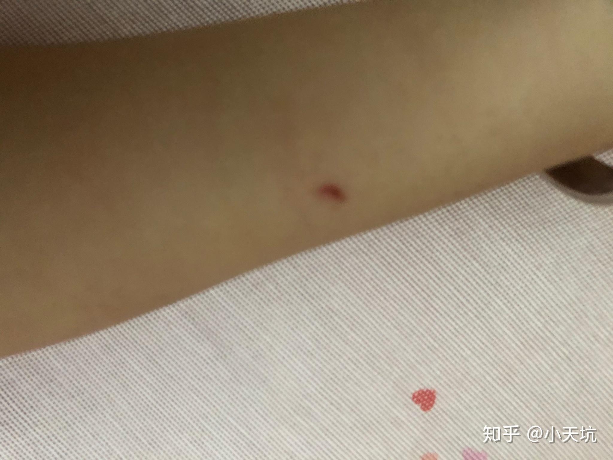 如果被兔子咬出血了就只把血擦干没消毒是话要怎么办啊血干了才想起来