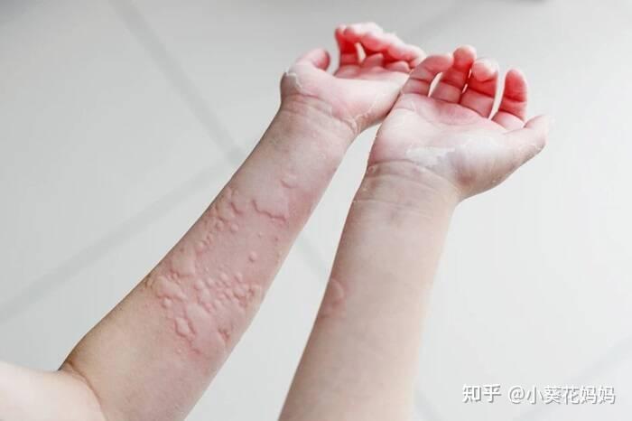 身上总是起荨麻疹风团,要弄清楚原因! - 知乎