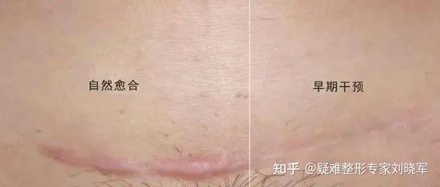 又痒又难看的剖腹产疤痕,可以通过这些方法改善 - 知乎