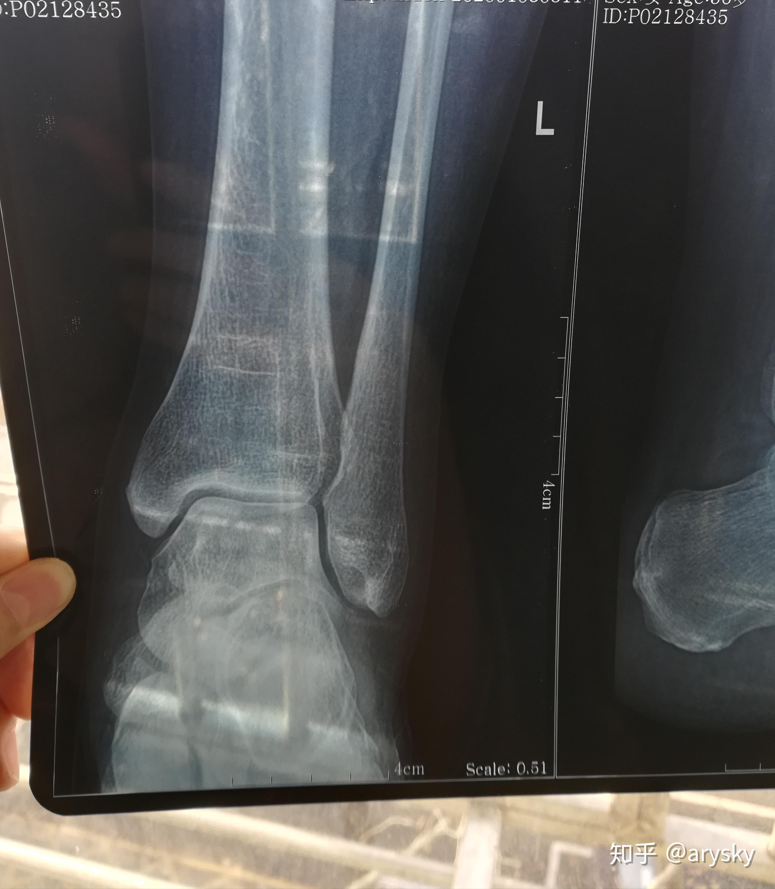 帮我看看脚外踝撕脱骨折了吗