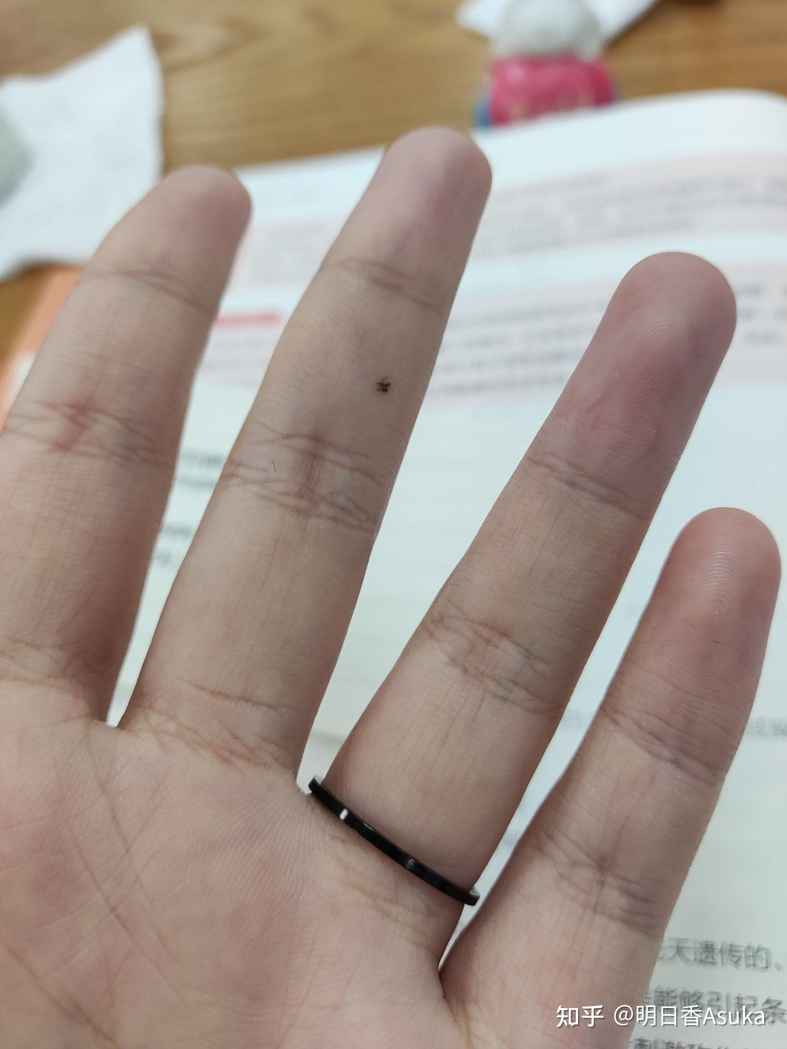 本人女左手无名指半年前多新长了一颗痣 有什么寓意? - 知乎