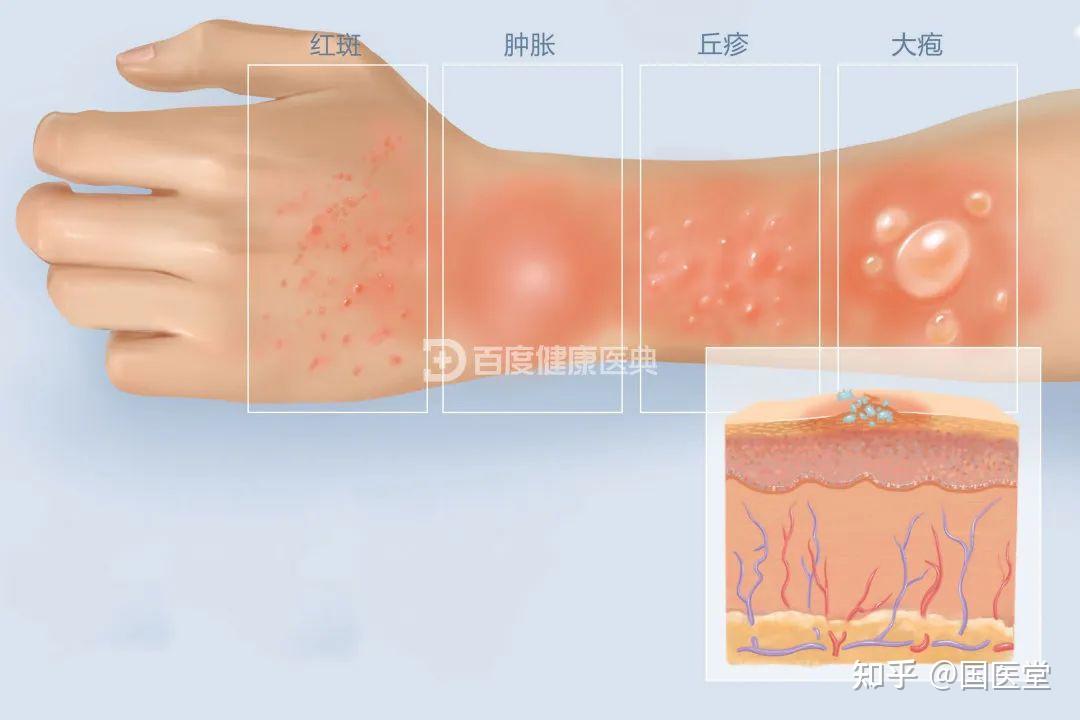 为什么会得接触性皮炎? - 知乎