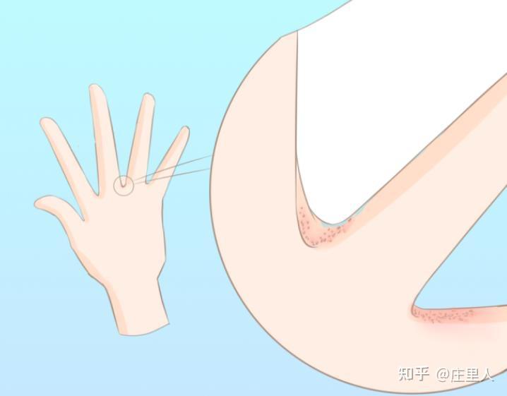 得了疥疮,是不是一块上海硫磺皂就能解决? - 知乎