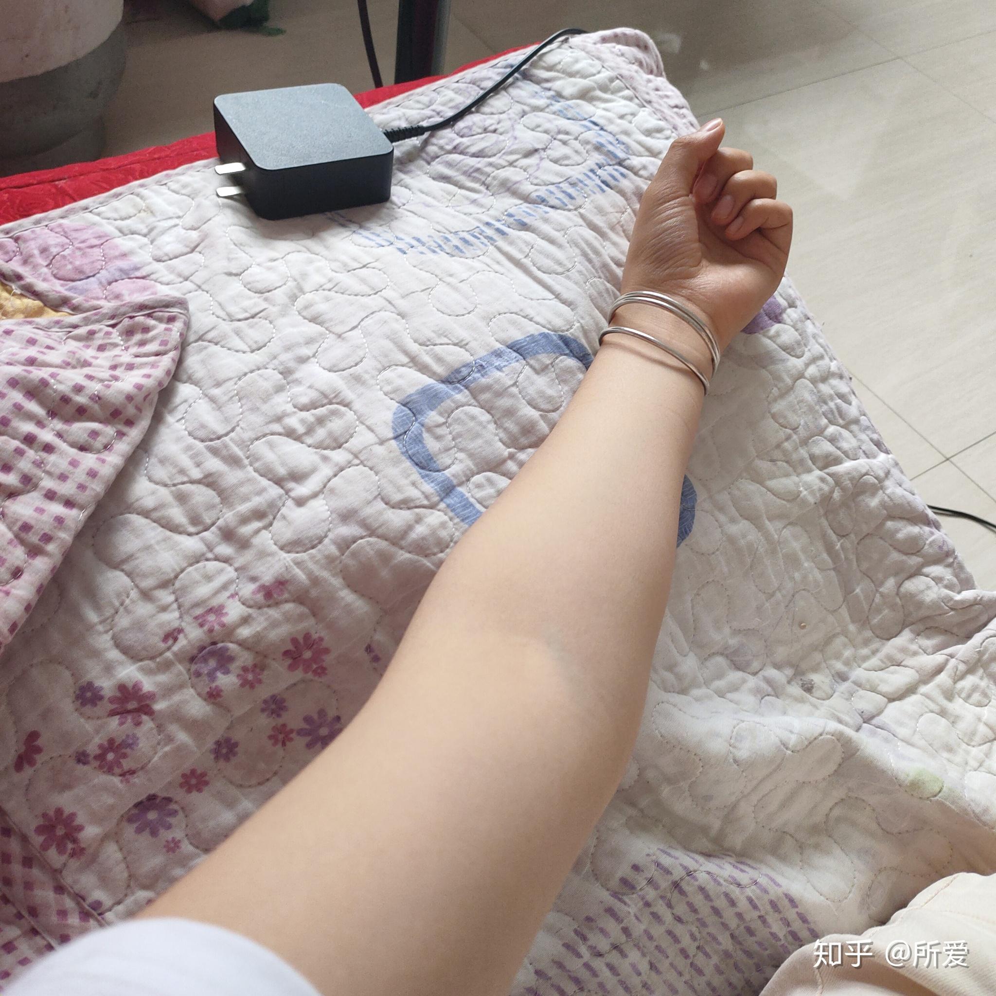 怎么看自己是不是胳膊外翻