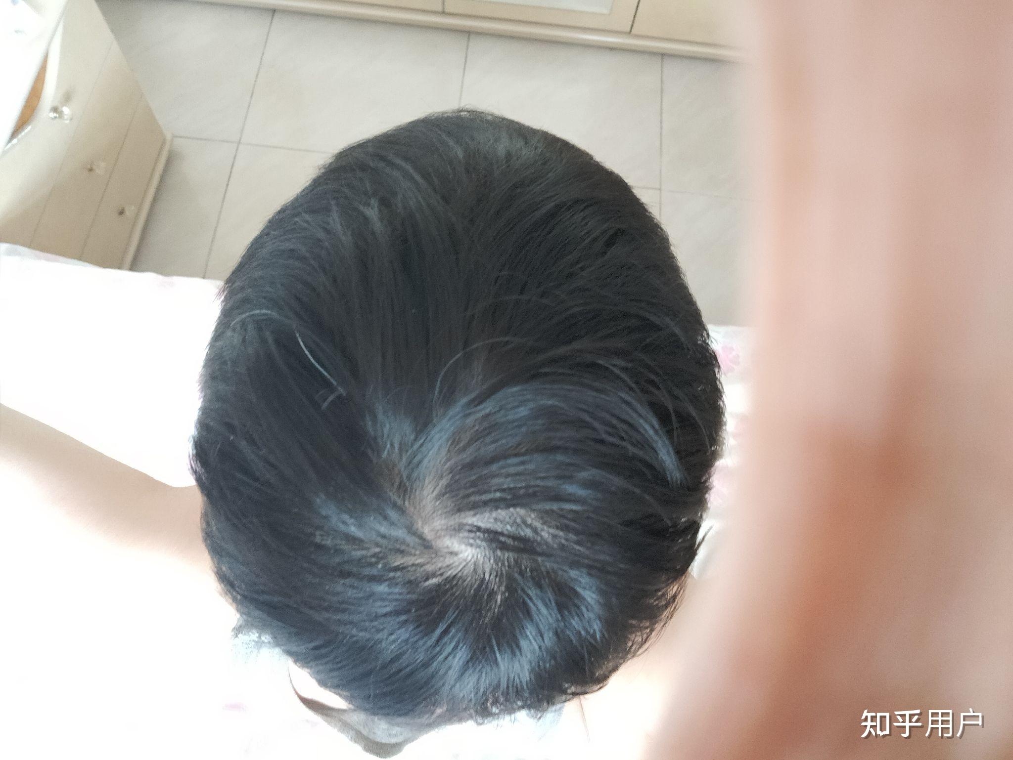 我这头顶漩涡处头发量正常吗