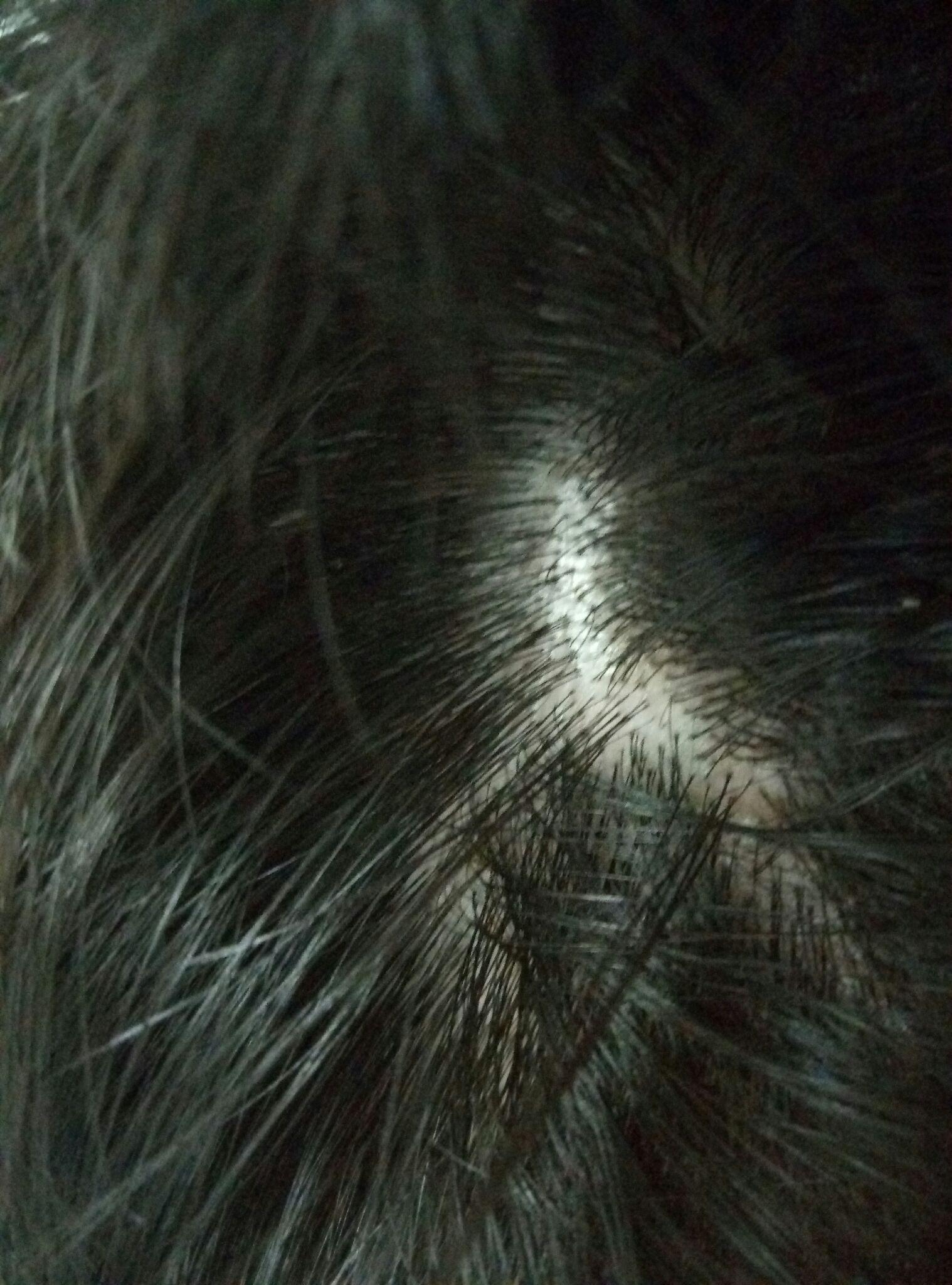 请问头部银屑病应该如何治疗