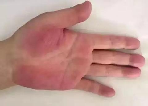 肝病预警的5个表现:从手掌、皮肤、脸色就能看出肝脏问题 - 知乎