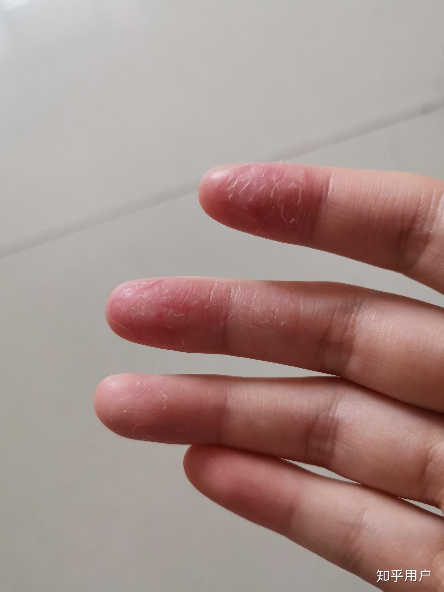 手指尖脱皮与气候季节的相关性是怎么形成的