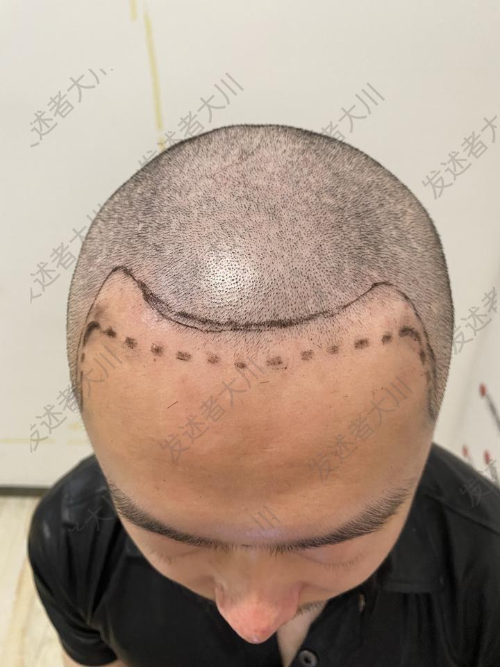 案例丨发际线种植成功后还会后移吗?看看我术后2年的效果~（解答99%的人关心的植发疑问...） - 知乎