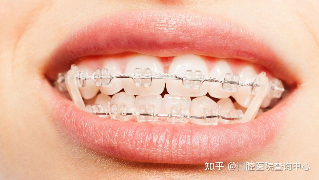 牙齿矫正是隐形牙套好还是金属牙套好