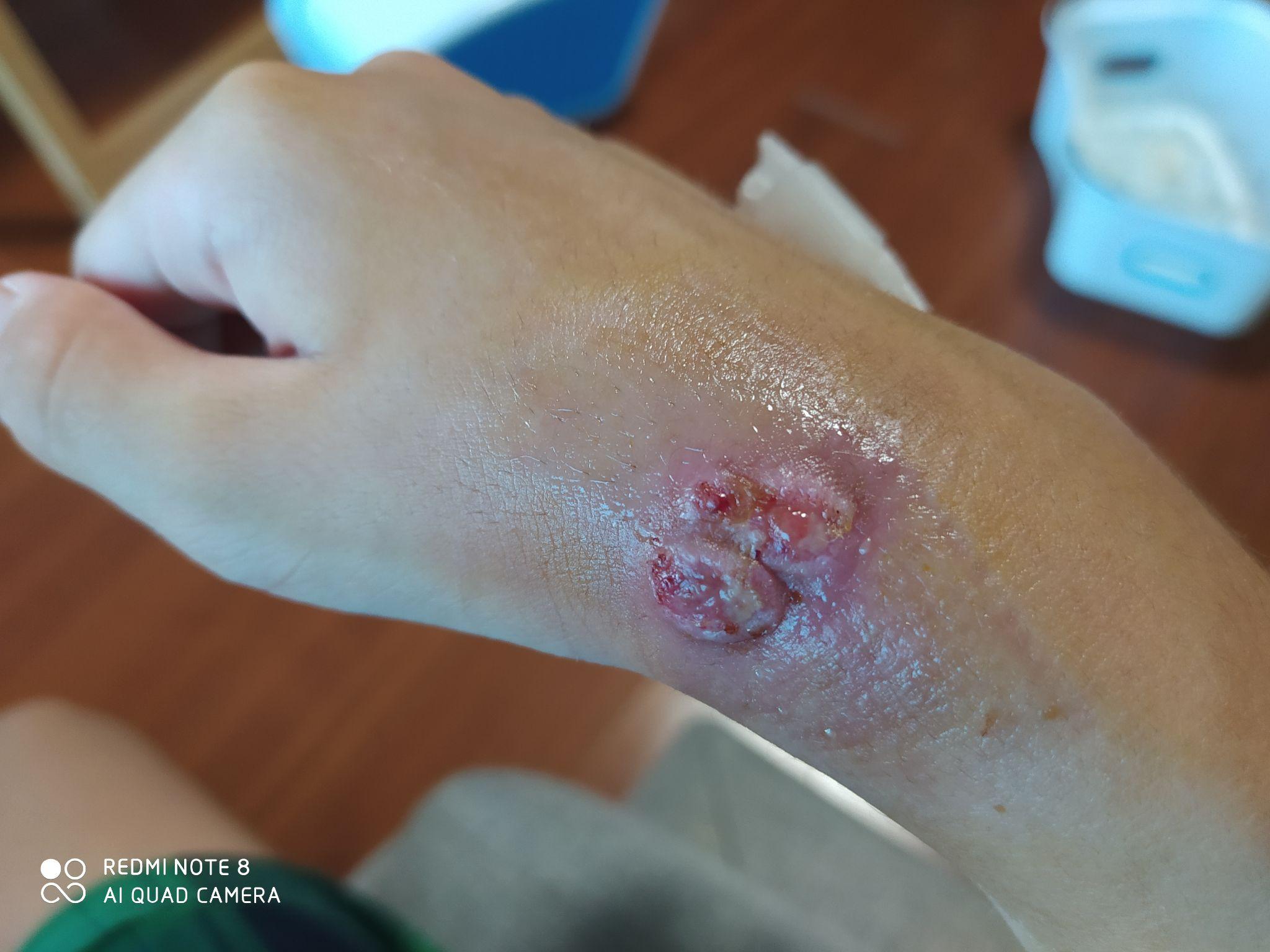 骨折取出外固定钢钉,长出的肉芽会留疤吗? - 知乎