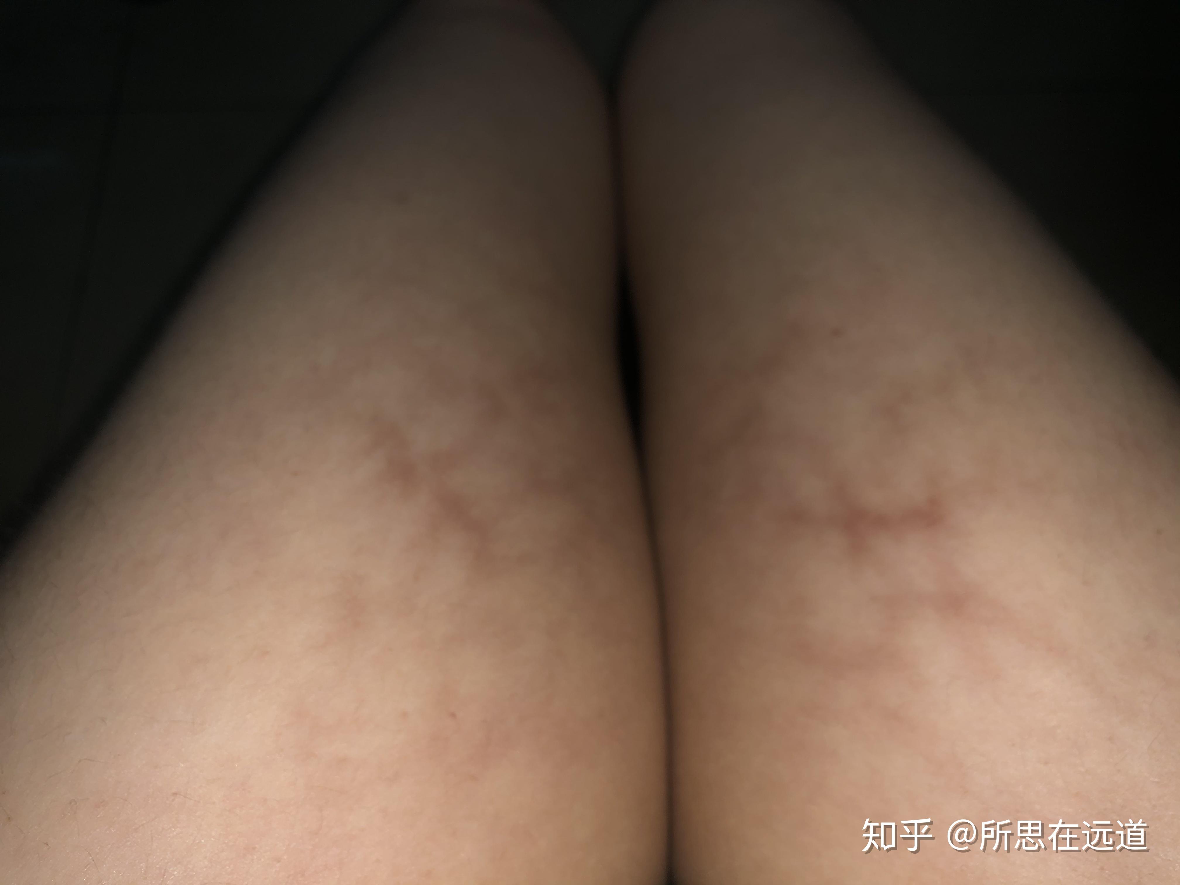 大腿内侧有红色网状条纹是怎么回事