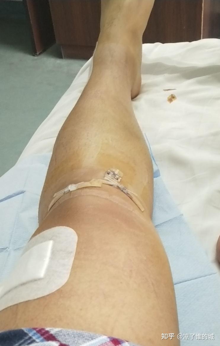膝盖前交叉韧带断裂是一种什么样的体验? - 知乎
