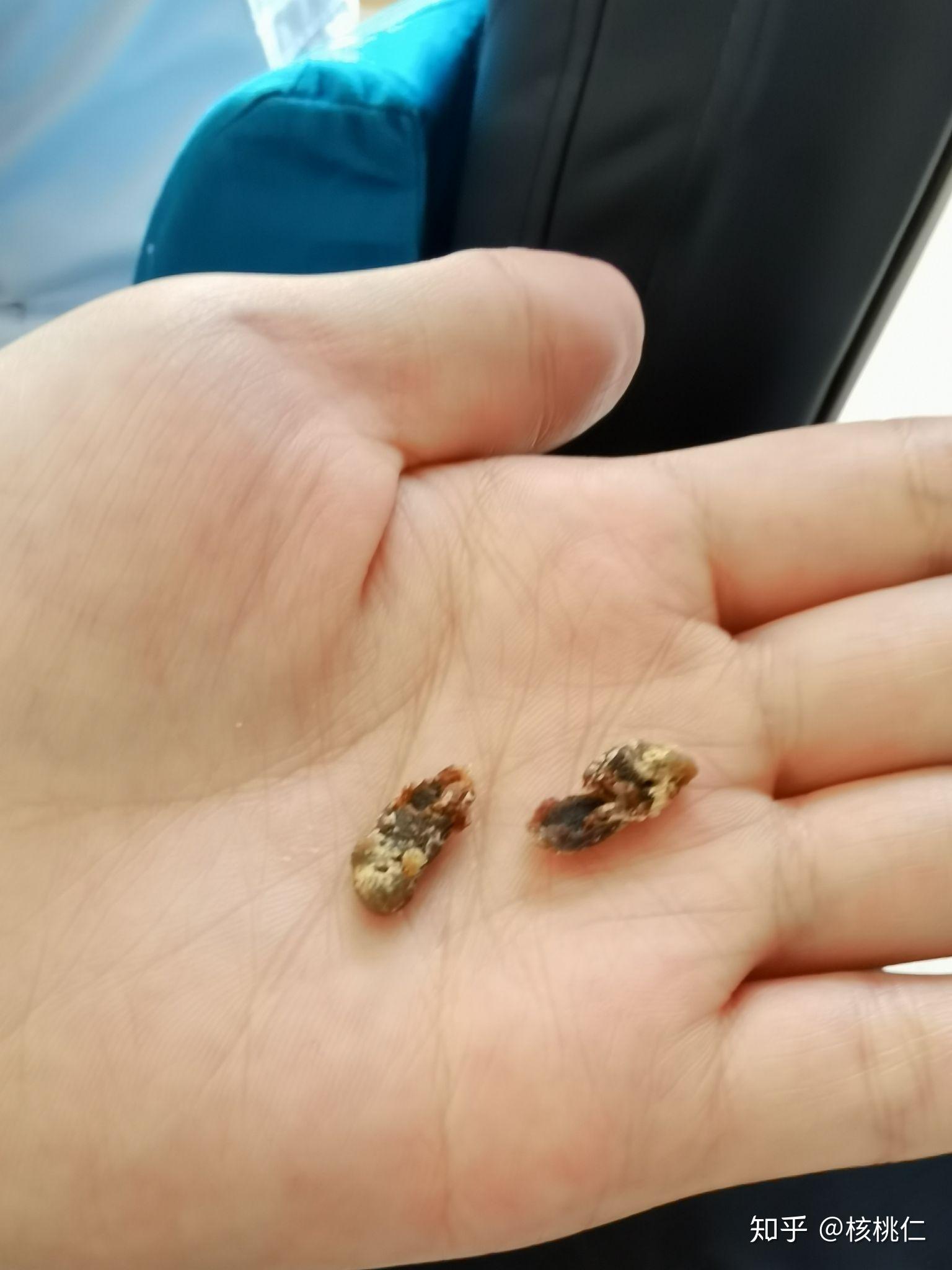 耳屎能大到什么程度? - 知乎