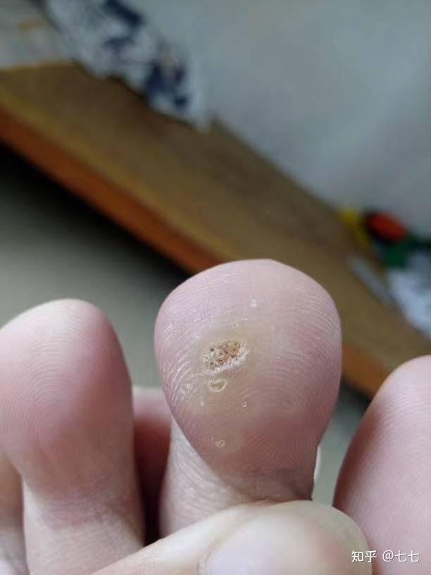 手摸了跖疣周围皮肤,会传染到其他地方吗救命?