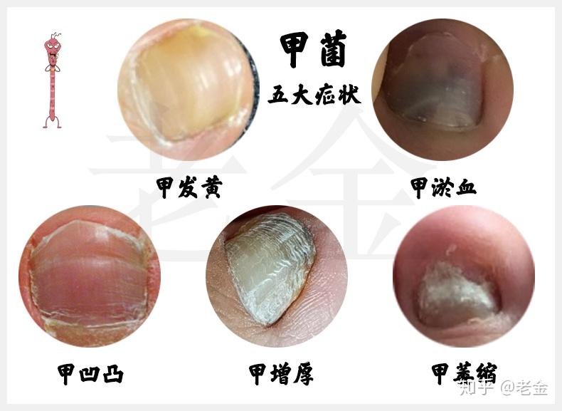 怎样治疗灰指甲? - 知乎