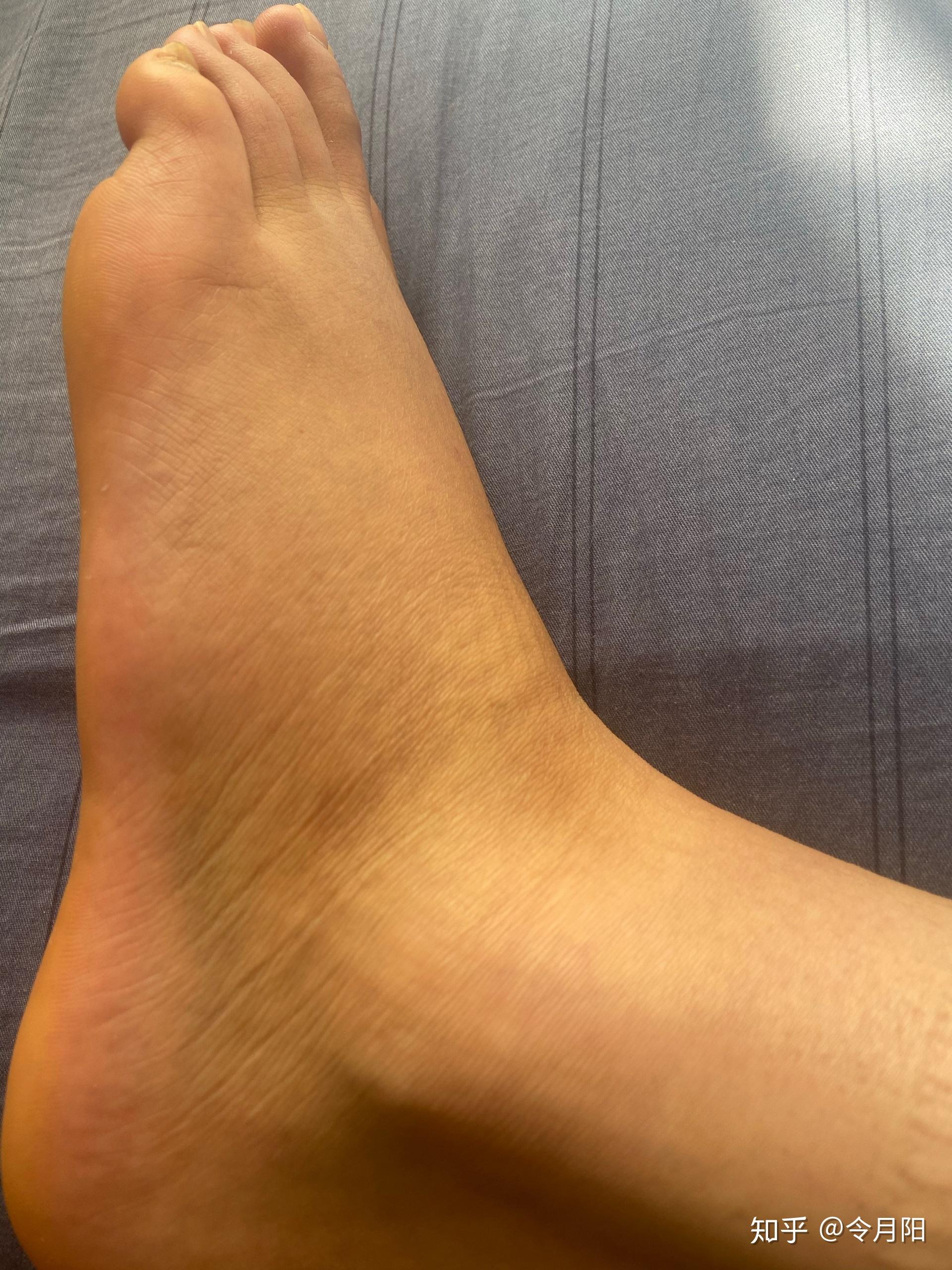 扭伤后脚背有肿块,请问怎么消肿? - 知乎