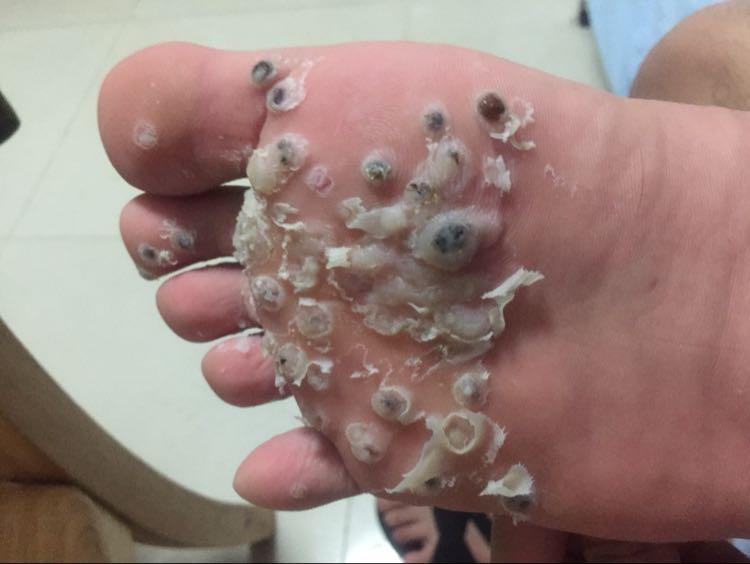 跖疣和鸡眼有什么区别医学上有没有什么治疗跖疣的好办法