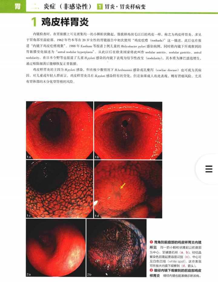 胃炎的概念及分类 - 知乎