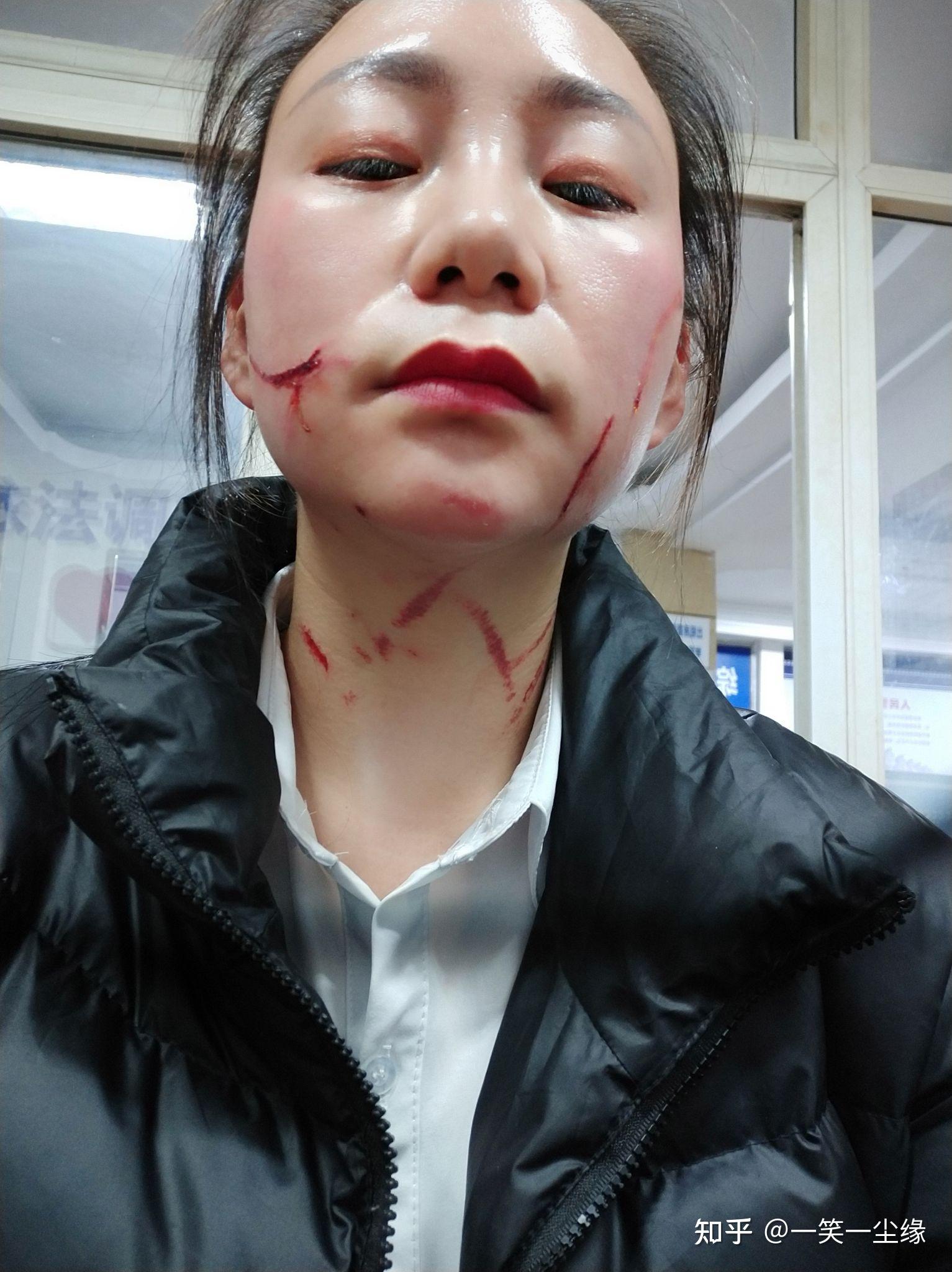 脸上被人抓了 刮掉几块肉 怎么处理才能快速痊愈且不留疤痕? - 知乎