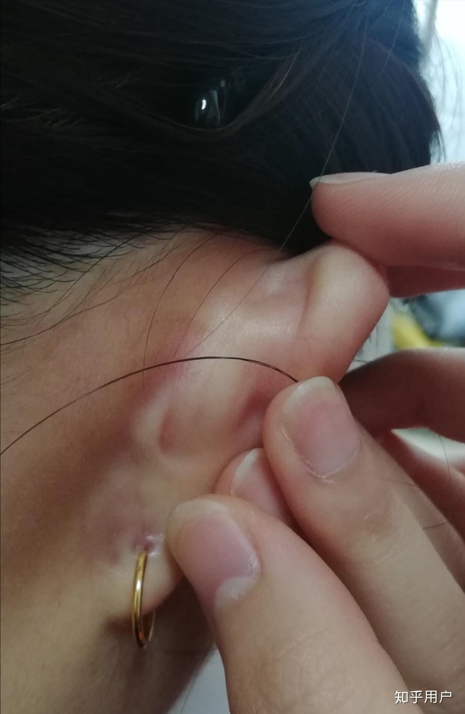 打完耳洞后耳朵后面长了个包是怎么回事