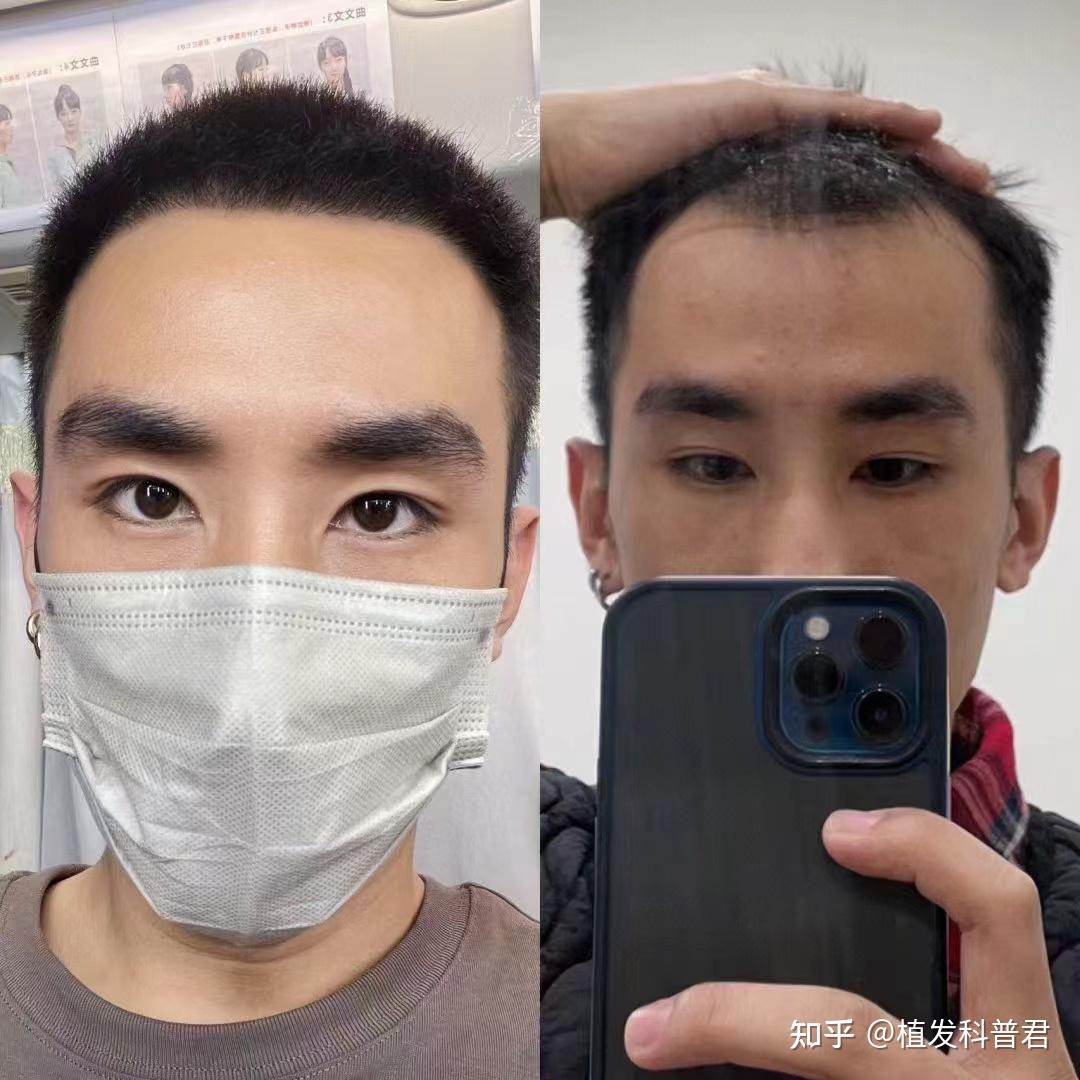 重庆的植发医院,做的好的都有哪些医院推荐? - 知乎