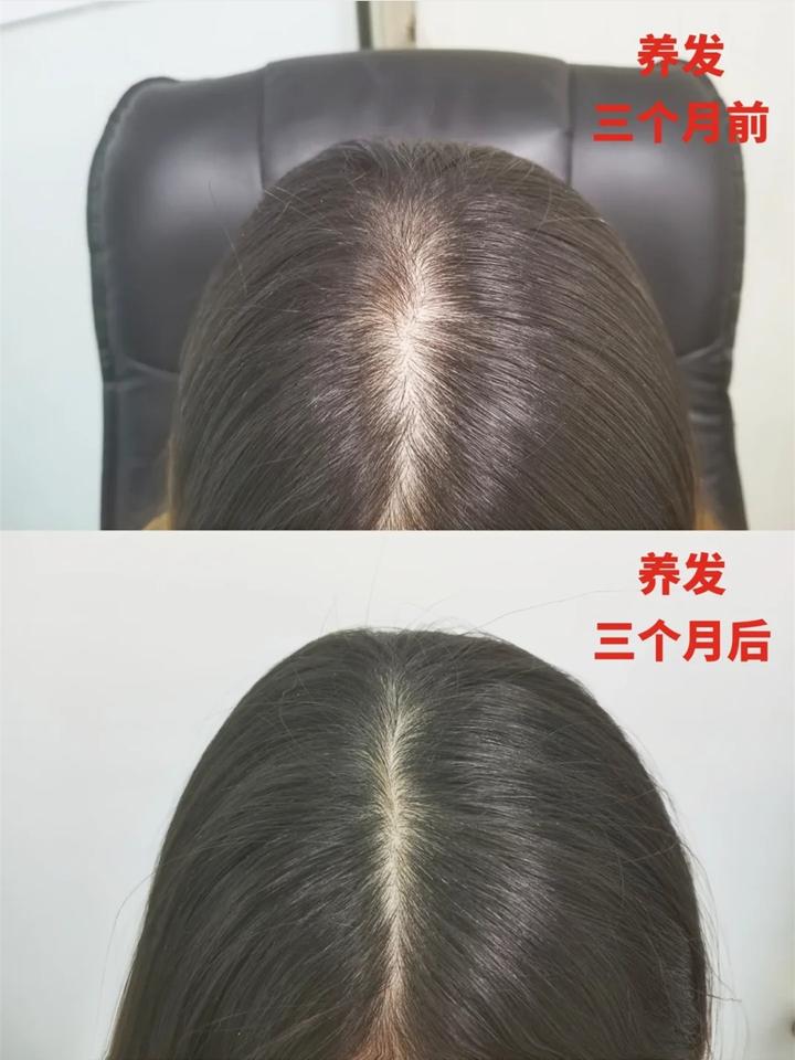 发缝宽怎么办？养发三个月，发量不输范冰冰 - 知乎