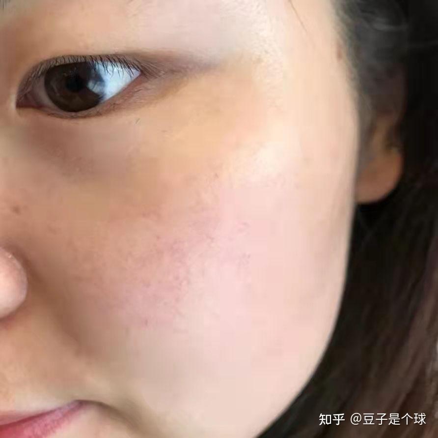 敏感肌脸泛红的你们用过超好用的护肤品是什么? - 知乎