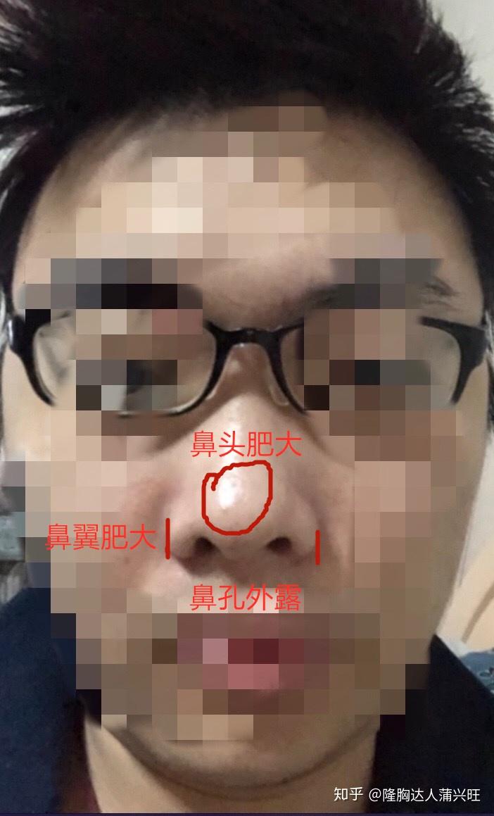 请问这种是朝天鼻吗