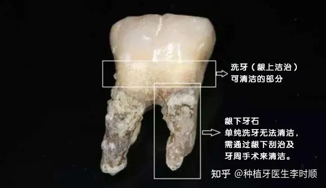 牙周炎龈下刮治是否有必要?利弊如何?