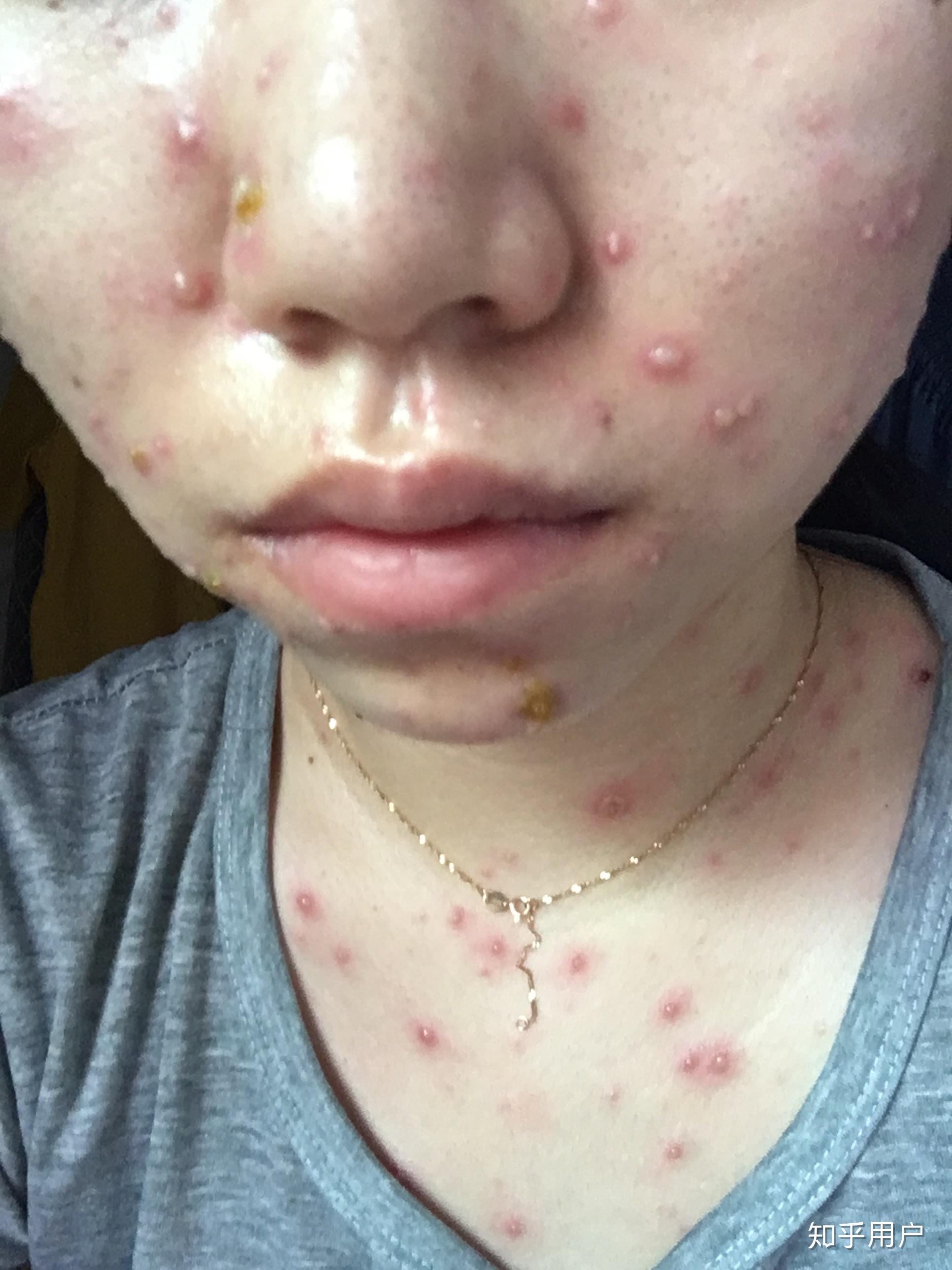 成人长水痘是什么样的经历