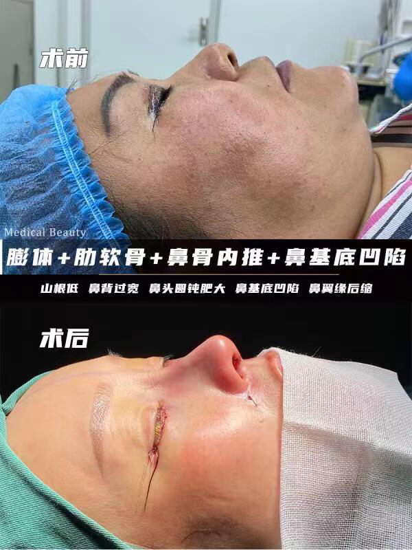鼻骨骨折 知乎