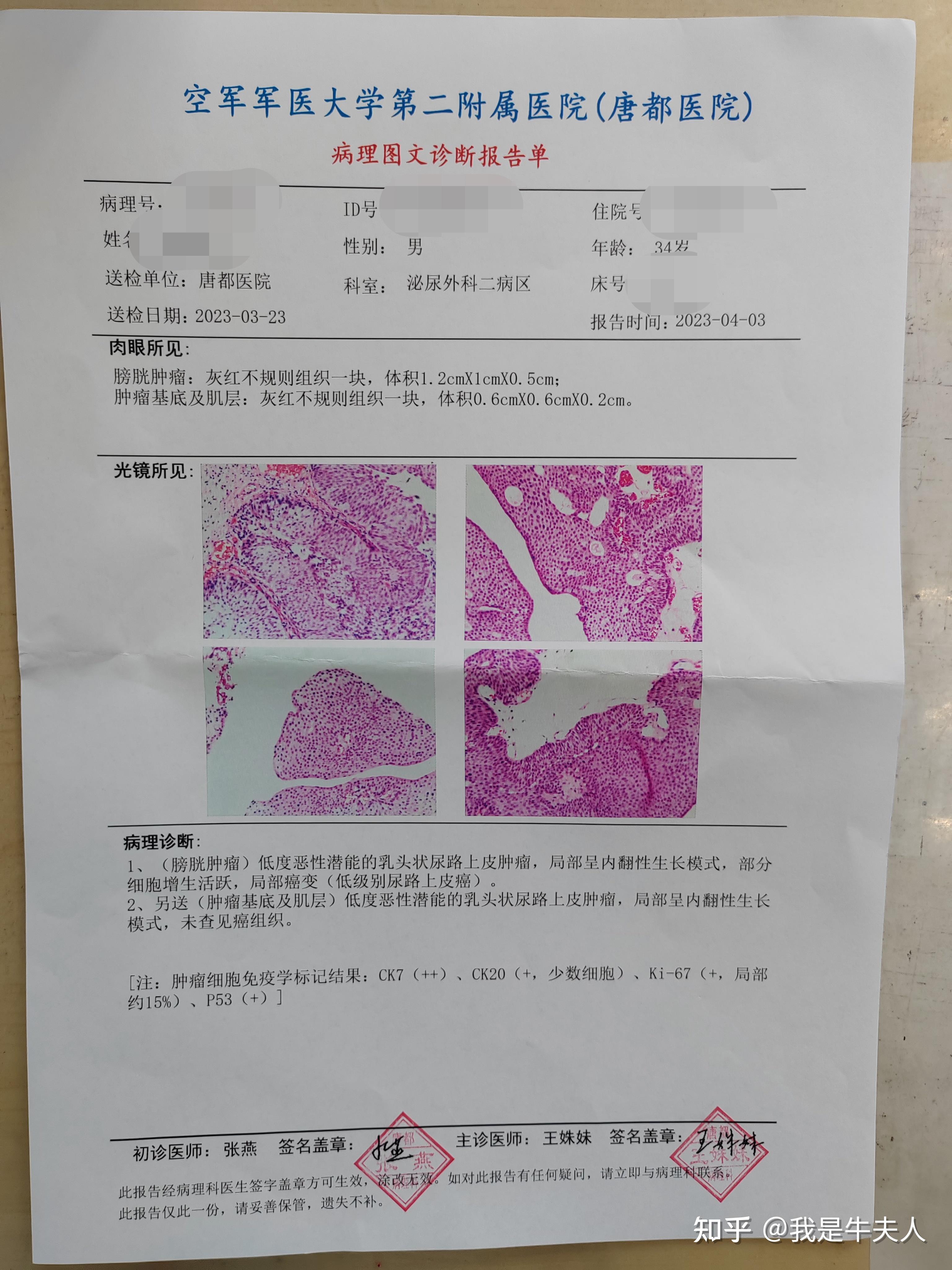 膀胱癌 病理报告图片