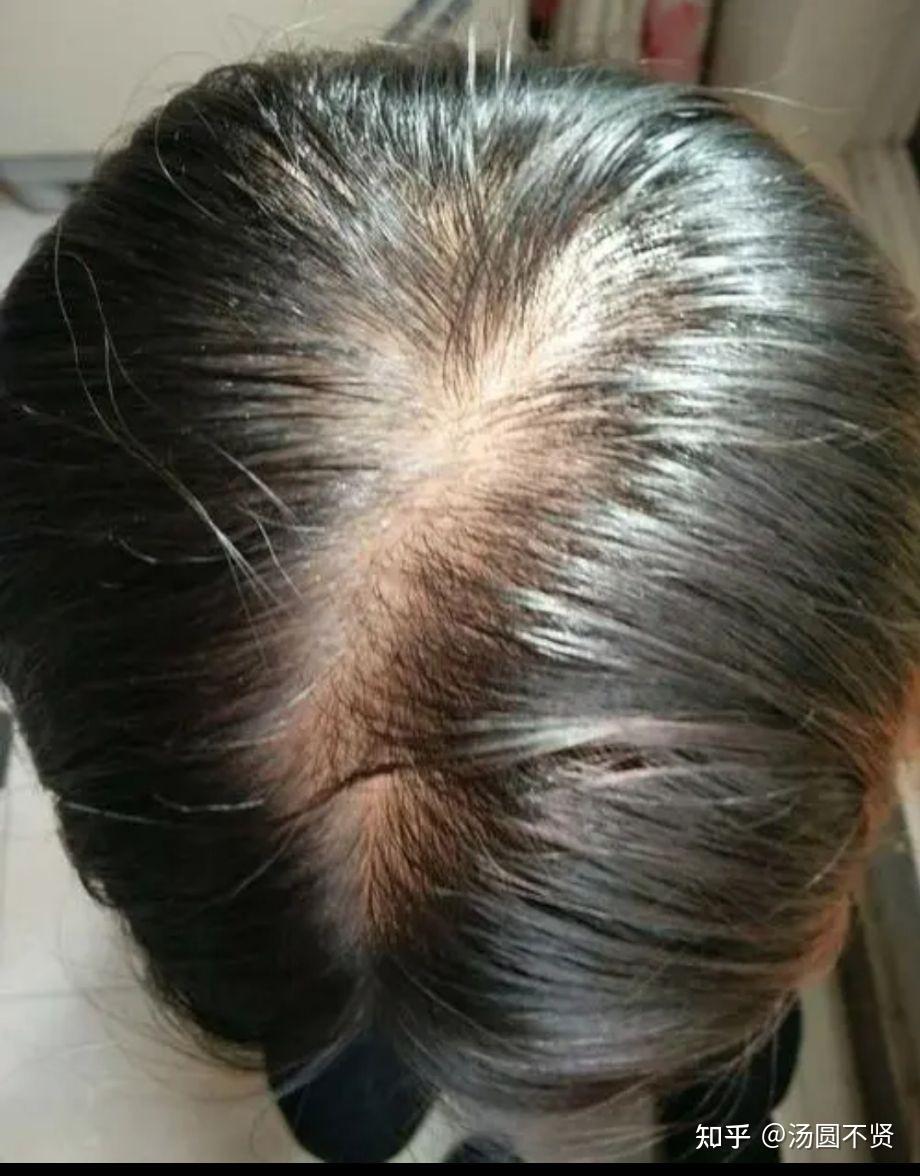 掉发厉害应该怎么解决