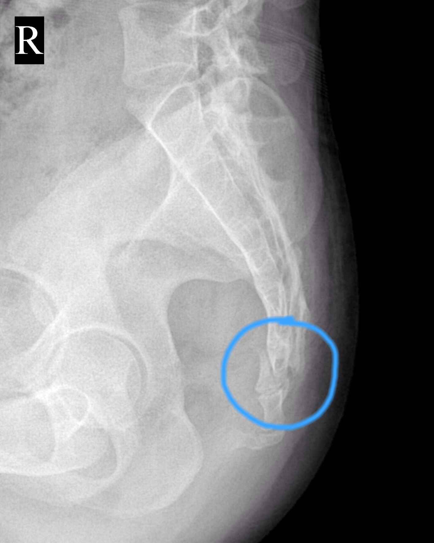 尾骨骨折是一种怎样的体验? - 知乎