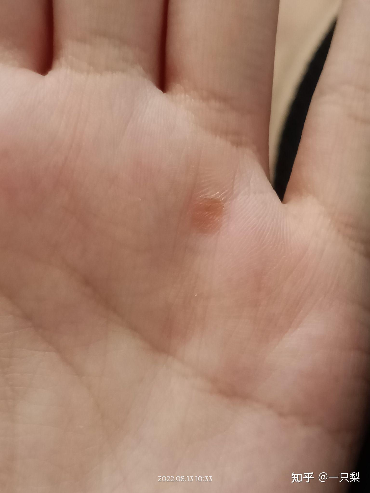 手掌上长了个透明的包