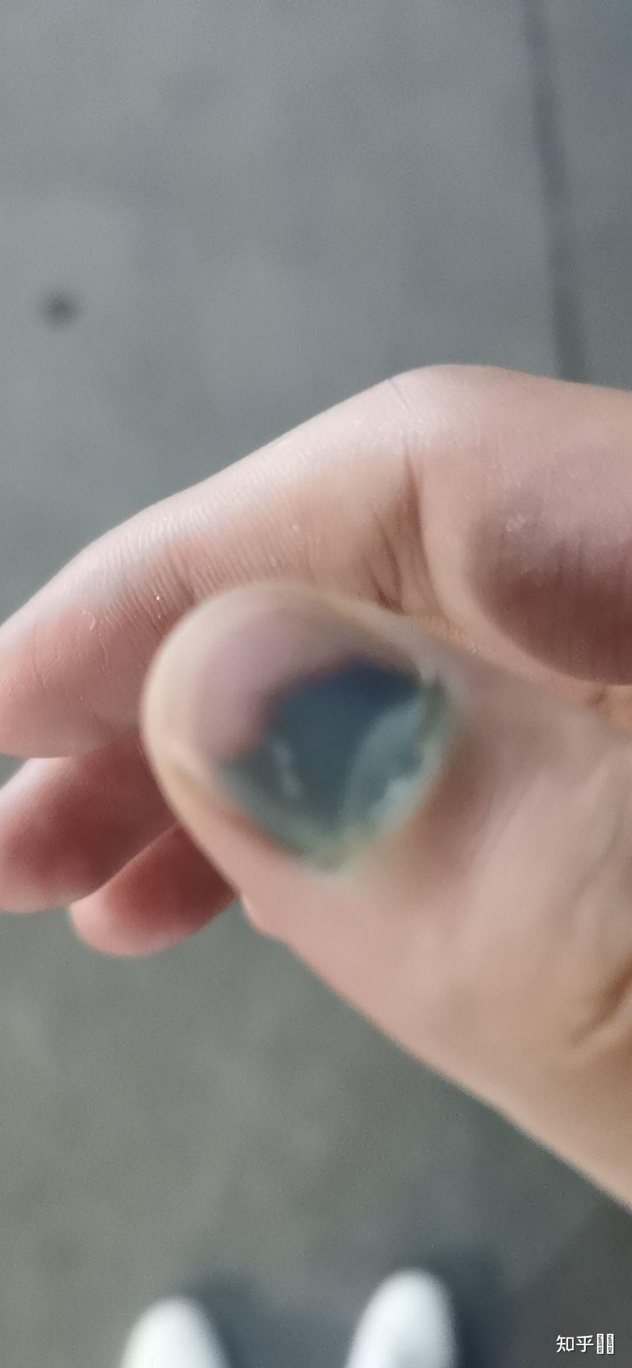 指甲被车门挤伤 指尖全是淤血 怎么办?