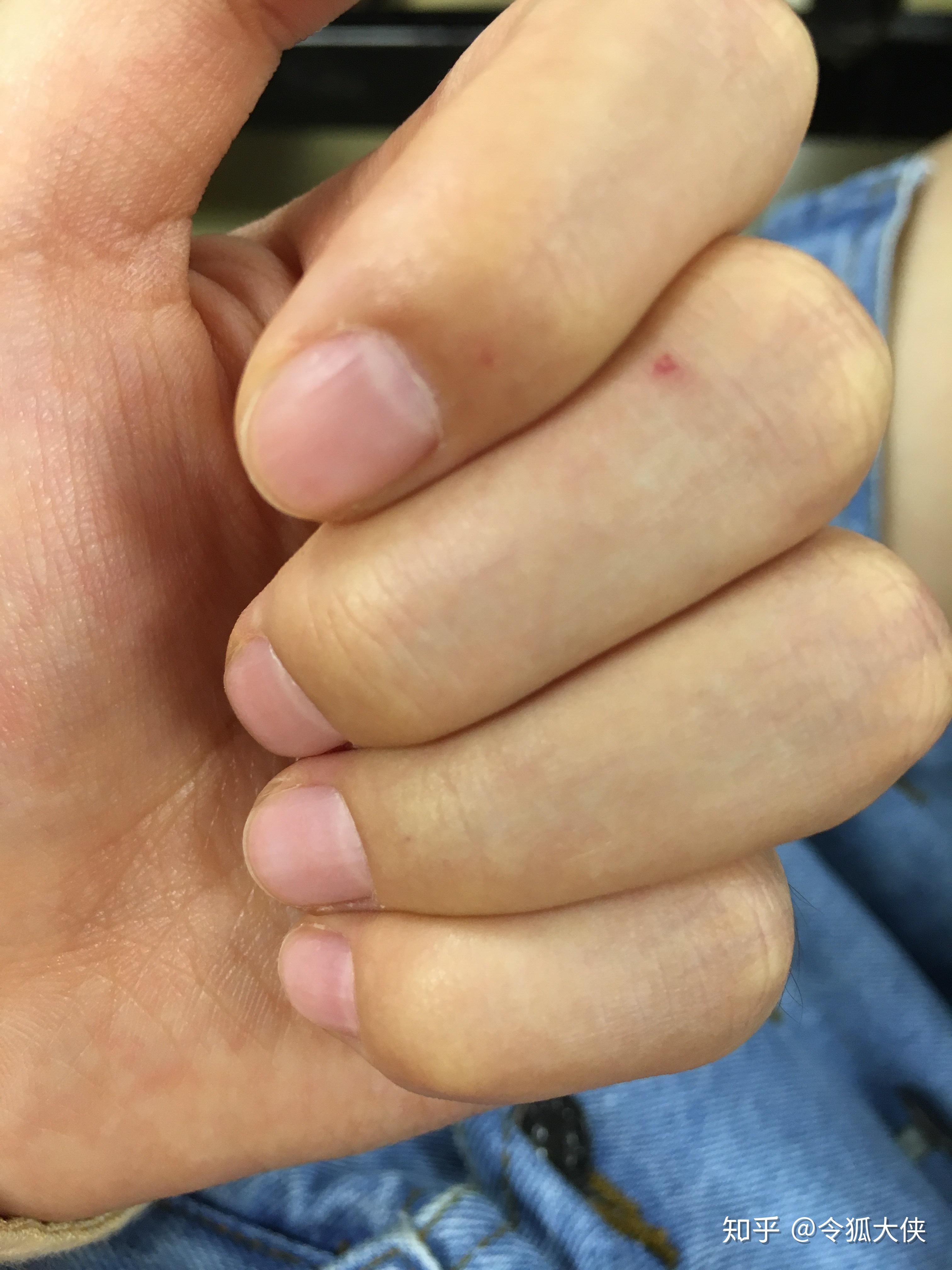 手指肚上长有小红点用指甲按会有针扎的感觉按下去也会让他消失请问