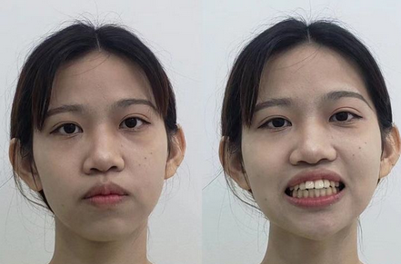 牙性龅牙侧脸图片
