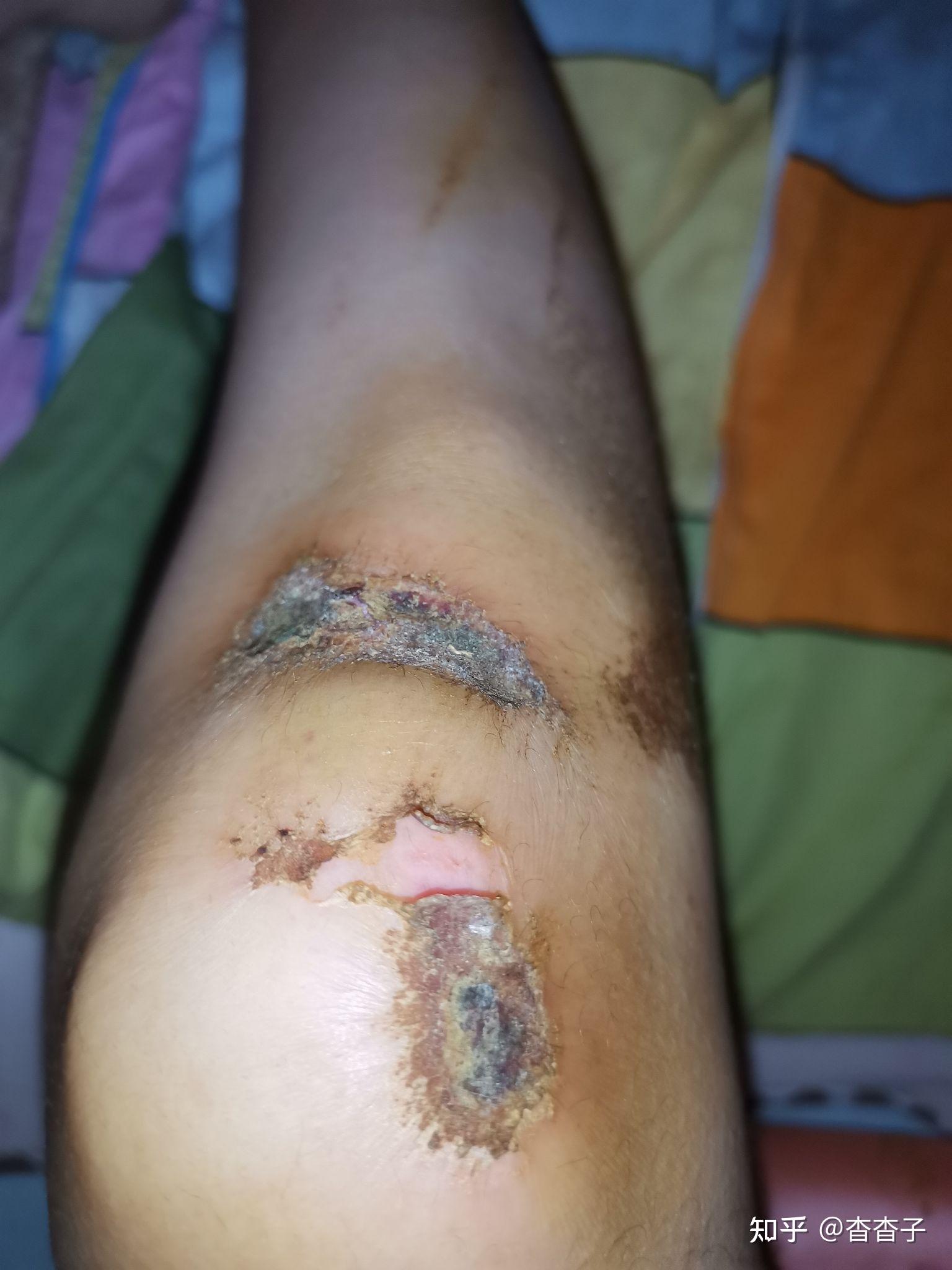 伤口愈合过程是怎样的?